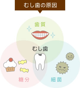 むし歯の原因「歯質」「糖分」「細菌」
